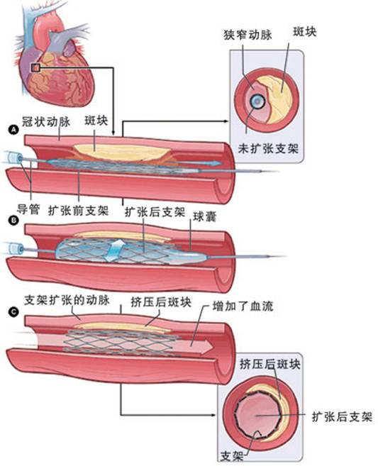 怎樣治療冠心??？(圖2)