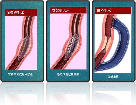怎樣治療冠心病？(圖1)